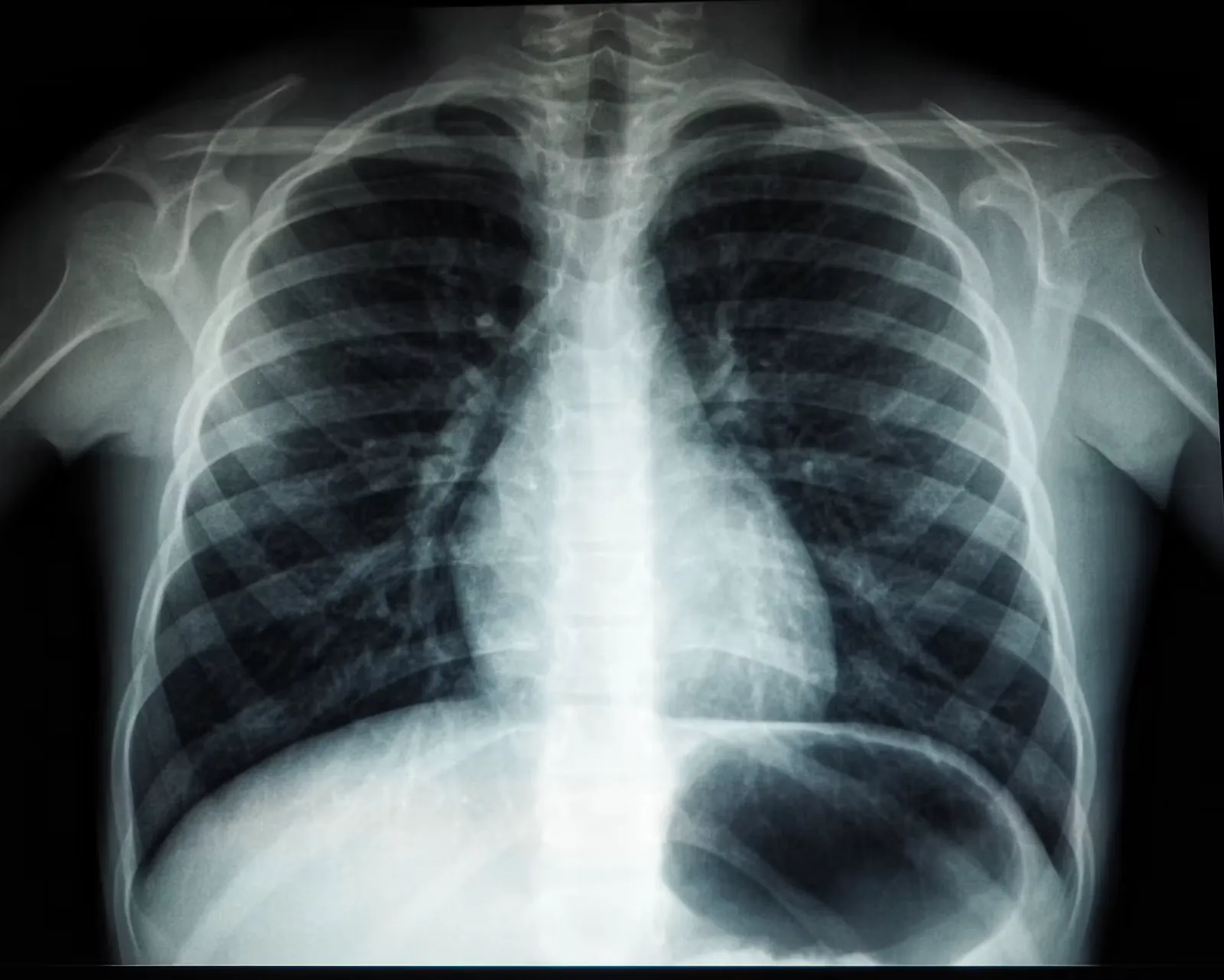 Tuberculosis on a Medical Elective: How to Stay Safe