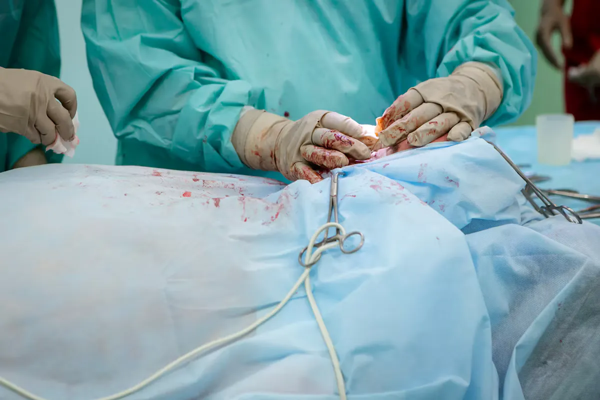 A general surgeon in a sea green gown and gloves working over sterile blue drapes with an artery forceps clipped in place