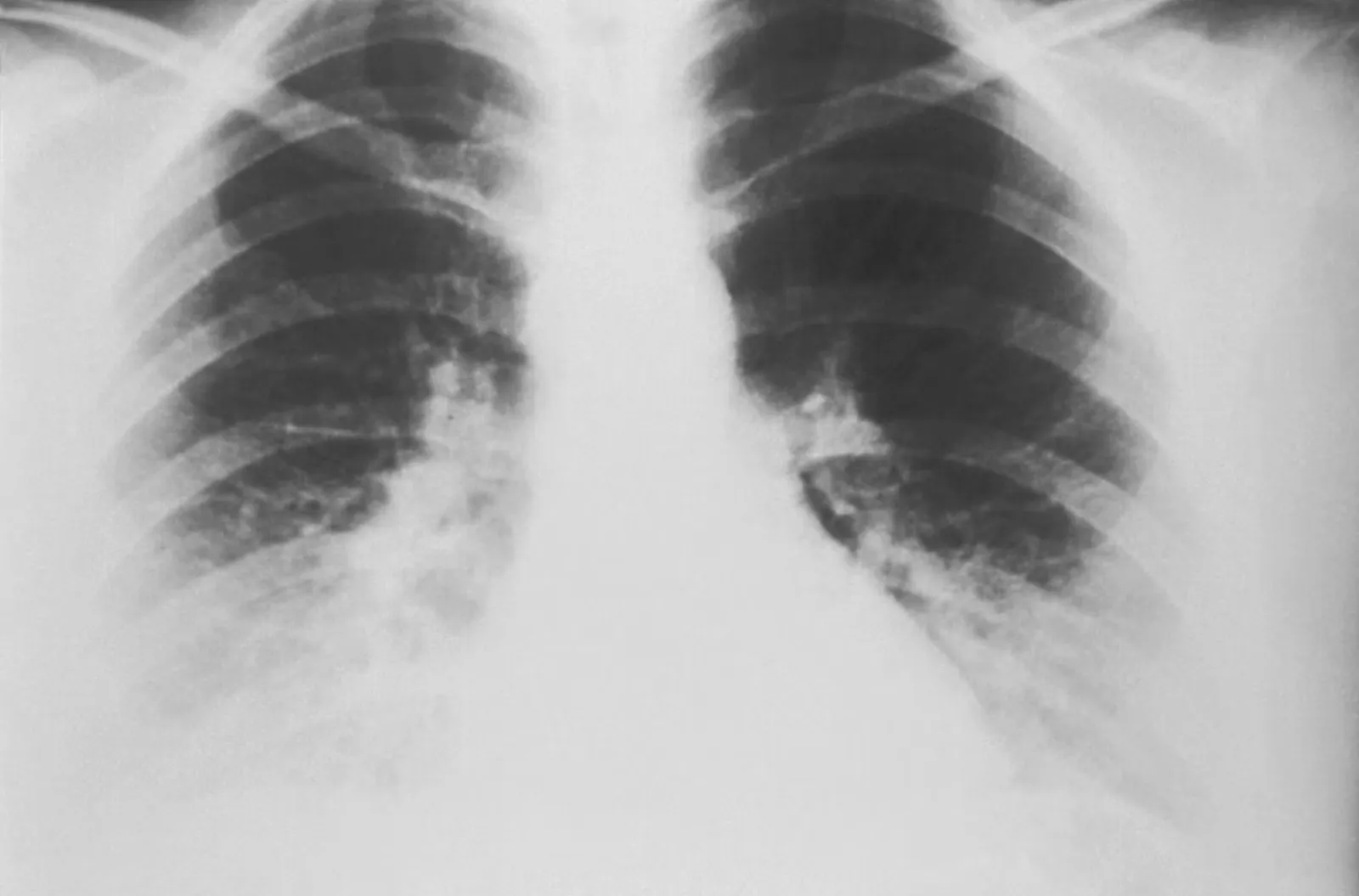 Tuberkulose im Auslandspraktikum: Risiko, Test, Schutz