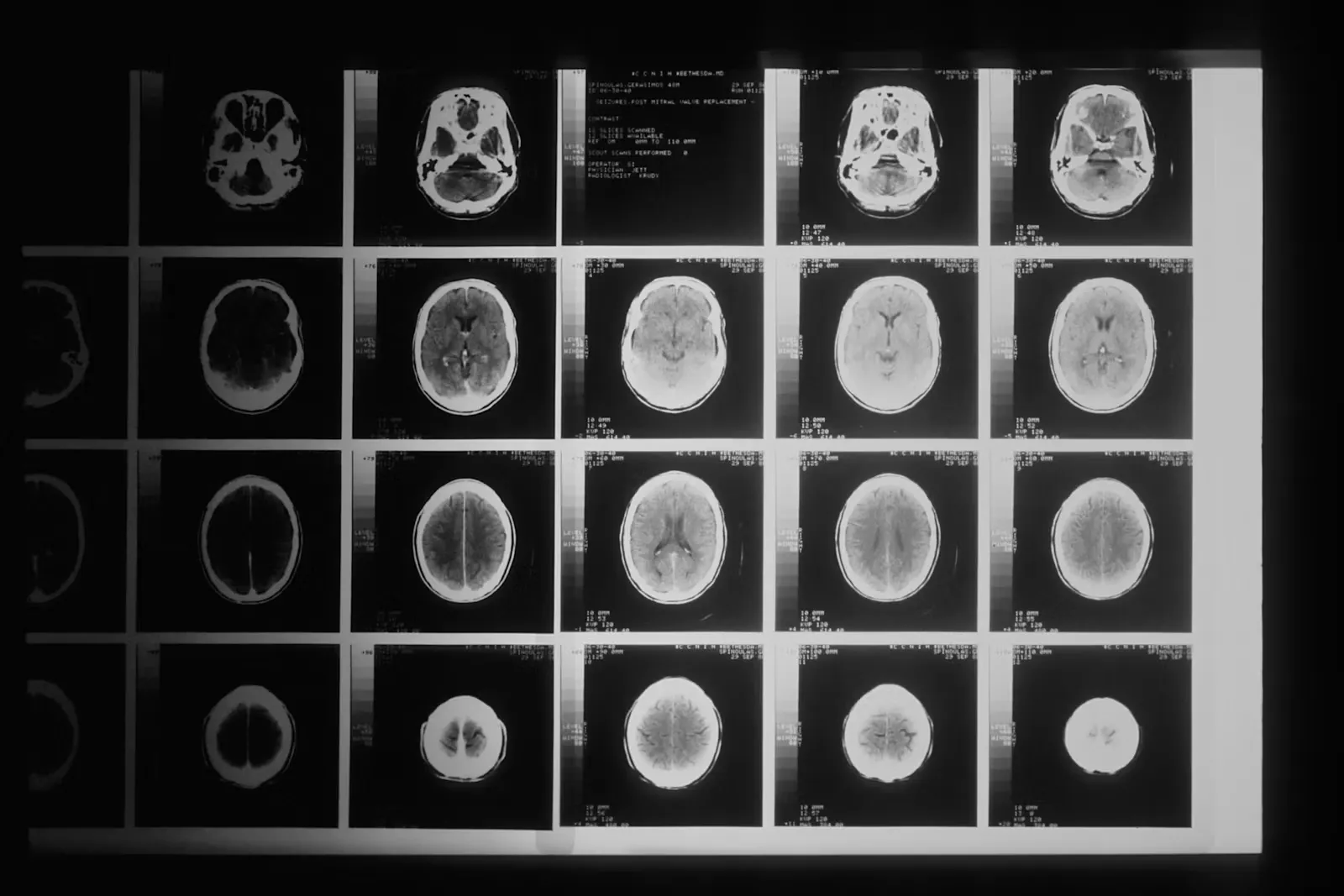 A sheet of black-and-white brain CT slices clipped to a light box, the kind of imaging a neurosurgery trainee reads every day