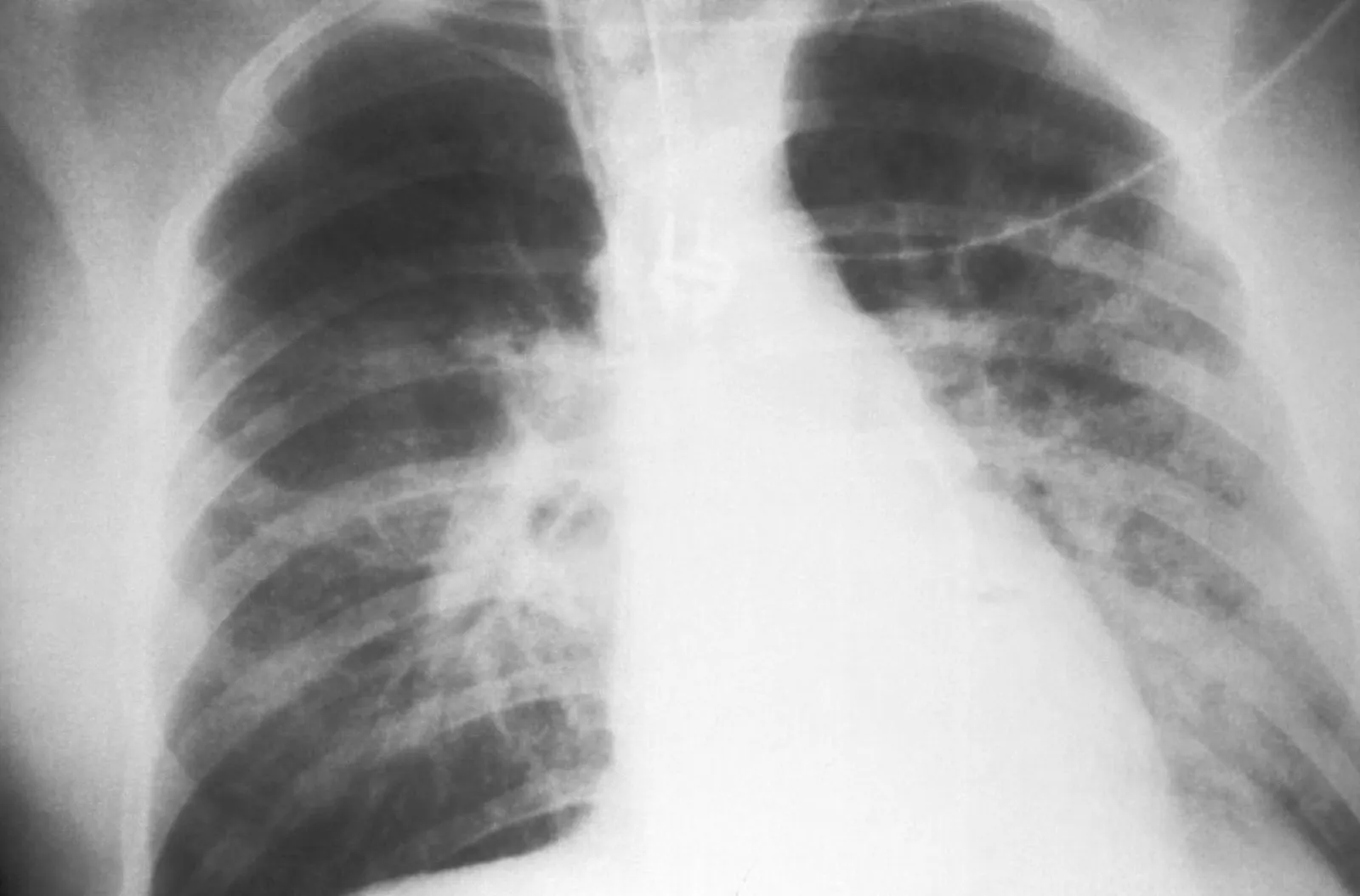 Tuberkulose in Famulatur und KPJ: Test, Maske, Risiko