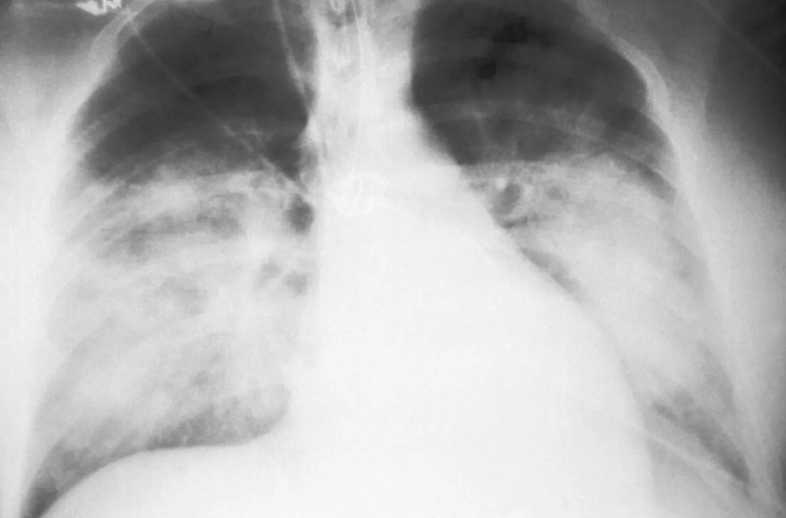 A frontal chest X-ray with hazy white shadows spread across the lower parts of both lungs